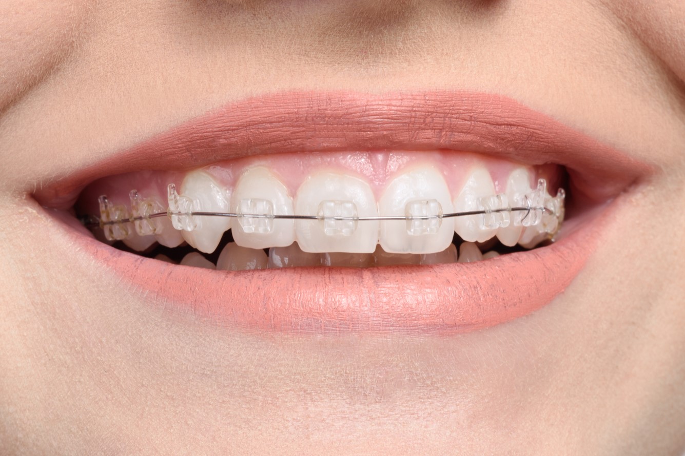 braces with ceramic brackets