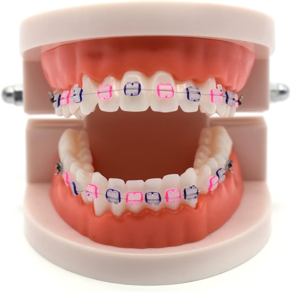 ceramic braces cost in kerala