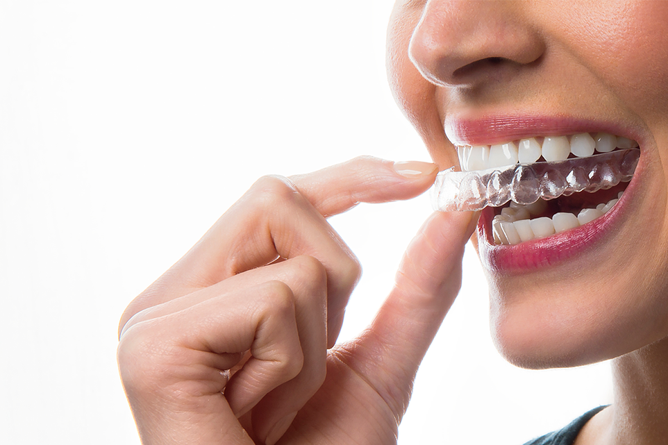 clear aligner cost