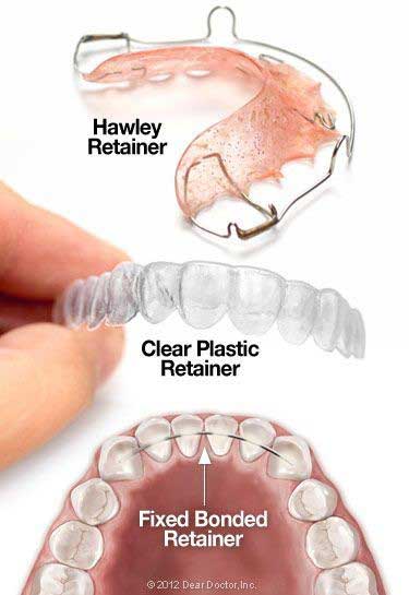 dental retainer types