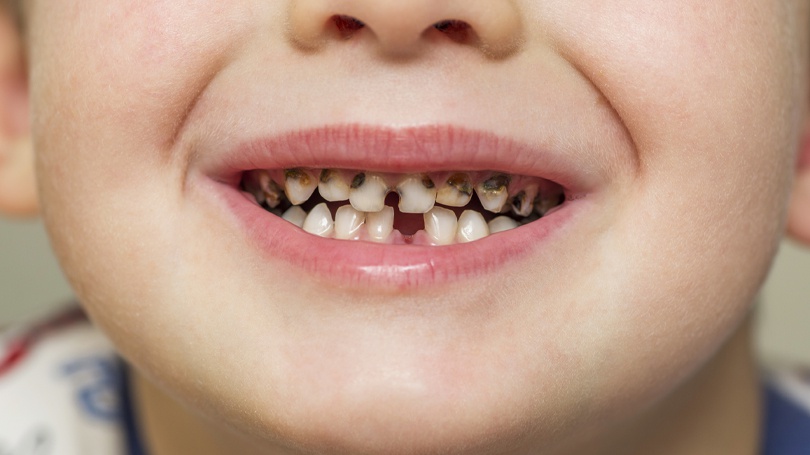 dental cavities in kids