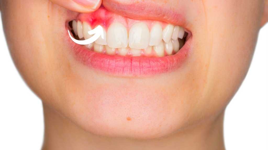 gum disease in kids