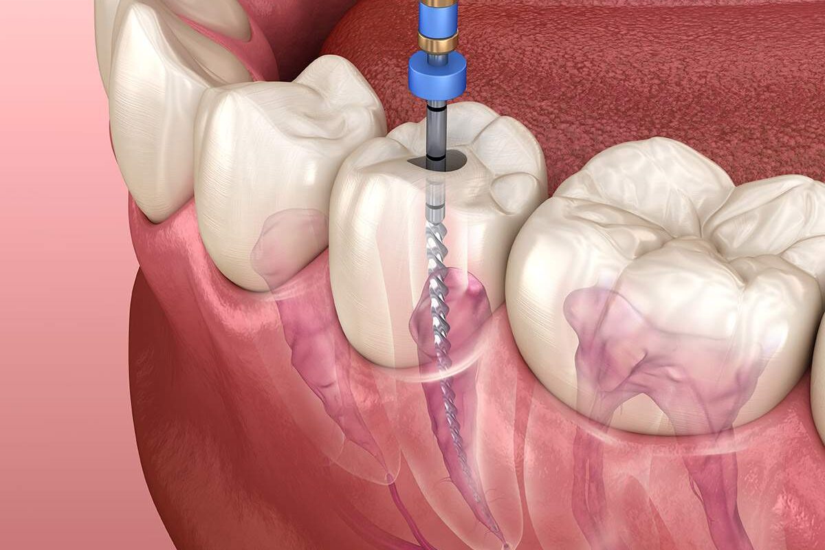 rct treatment cost kochi