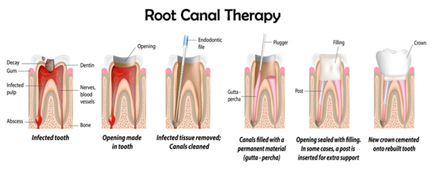 rct treatment procedure