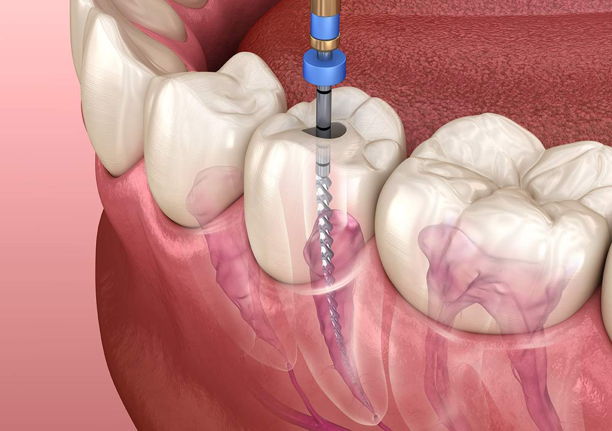 rct treatment cost kochi