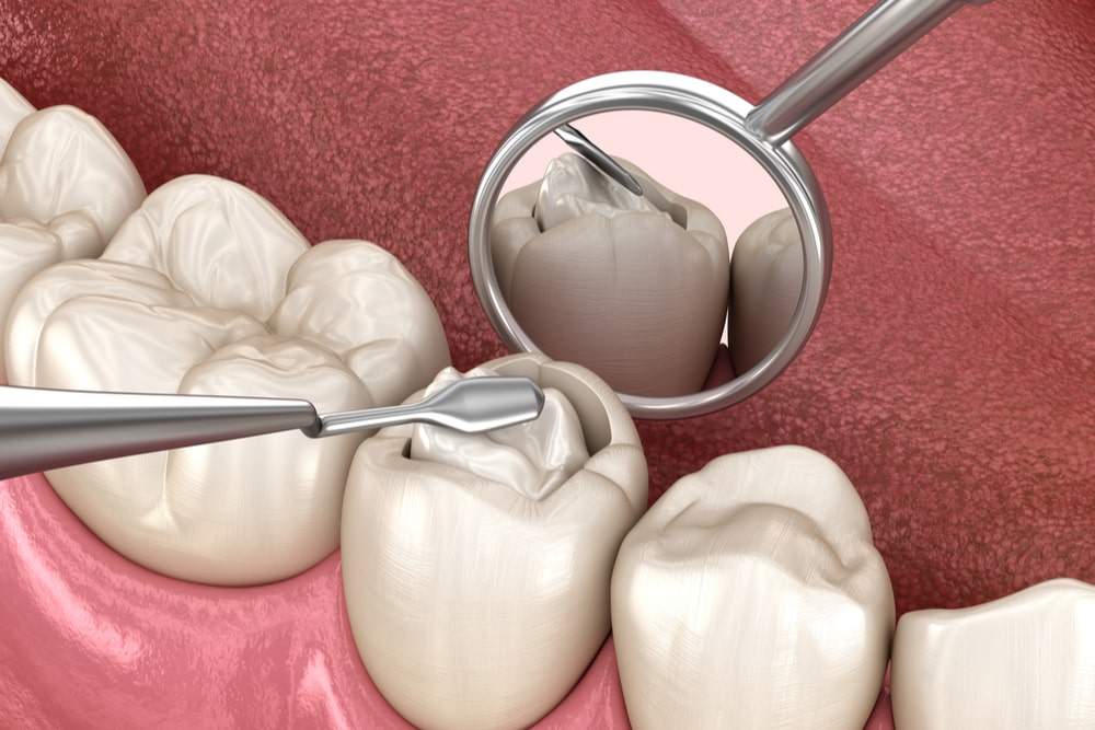 tooth filling composite