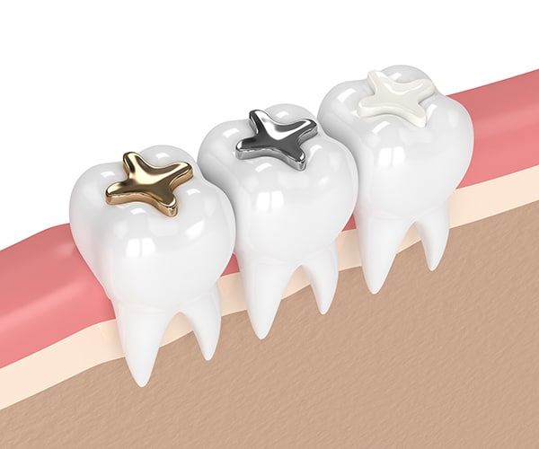 types of tooth fillings