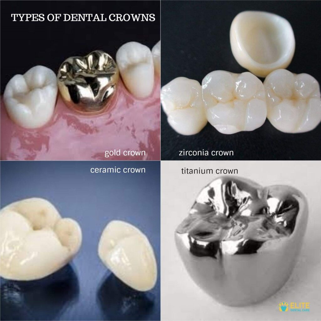 dental crown cost