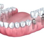 dental implant