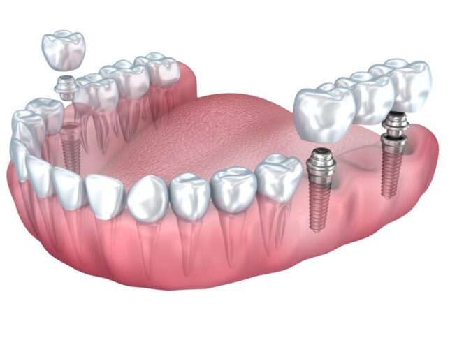 dental implant