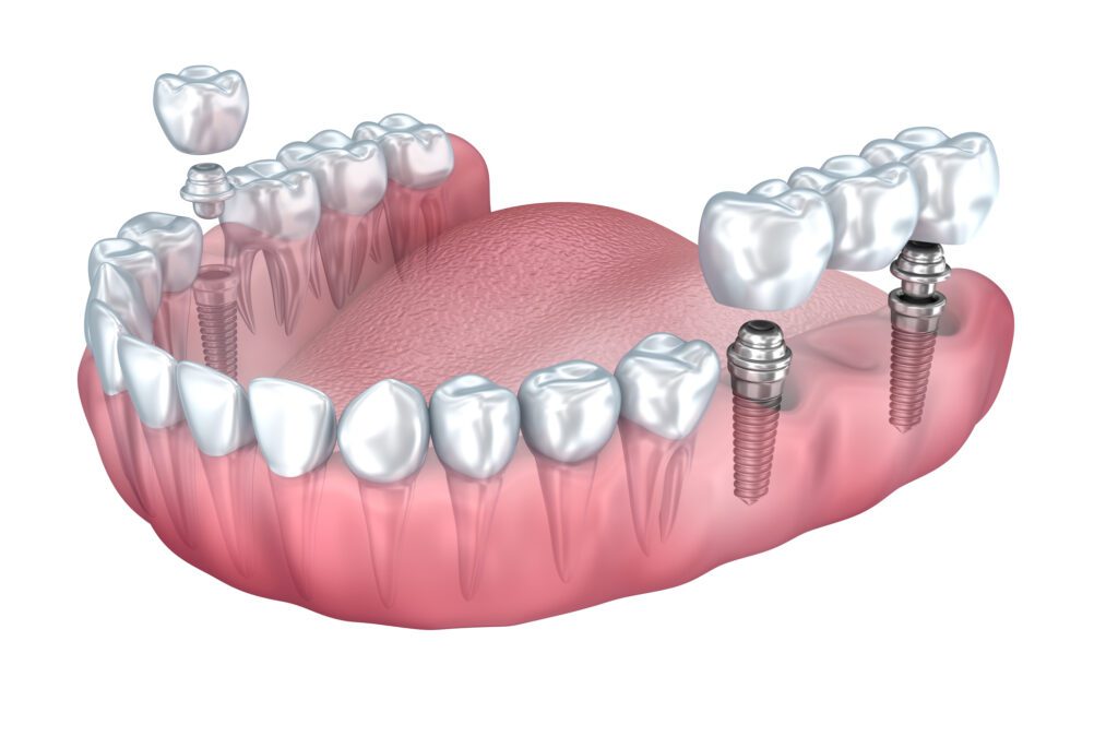 dental implant