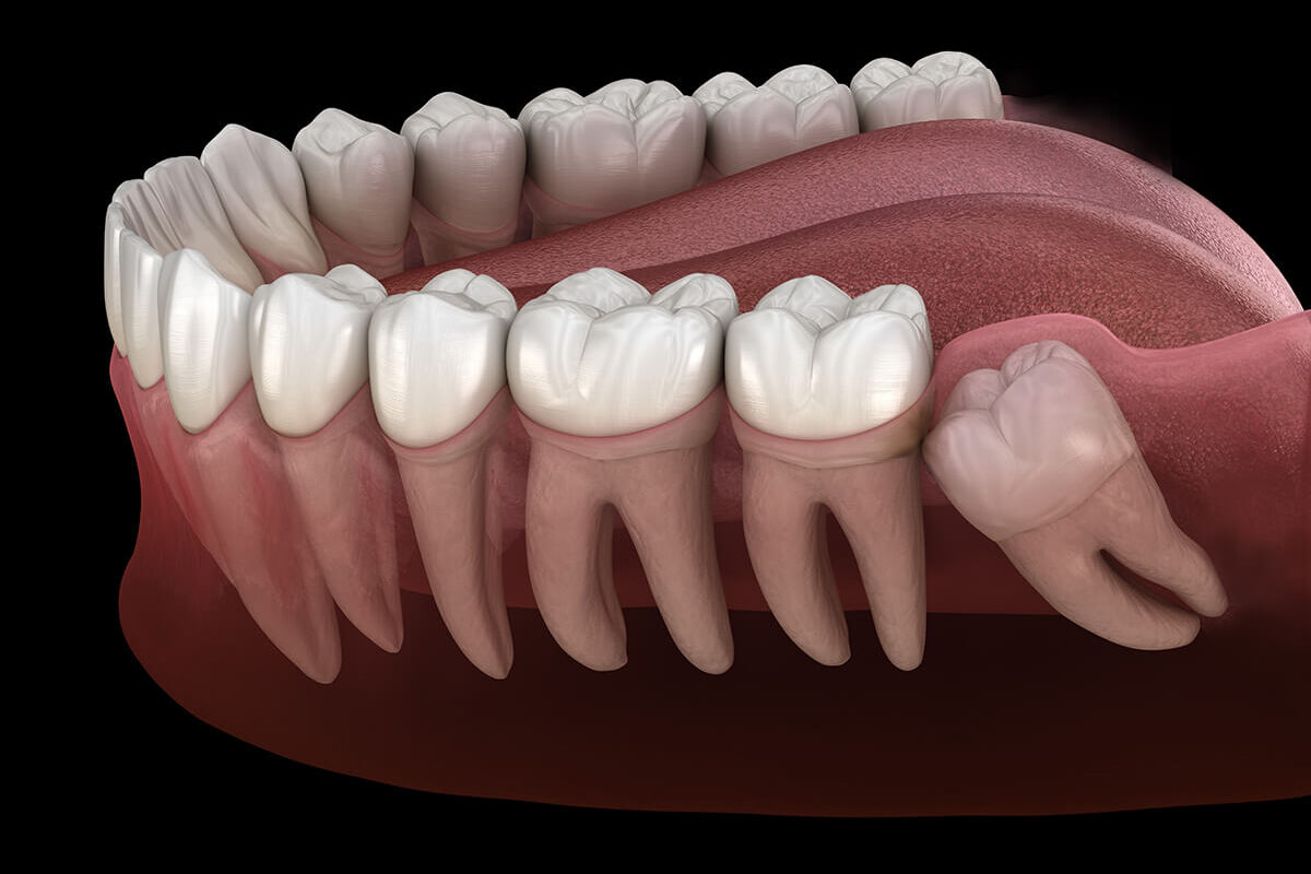 wisdom tooth