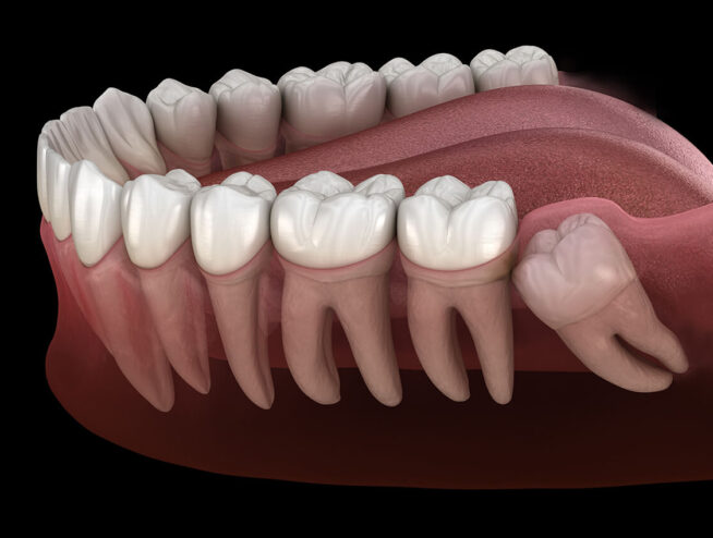 wisdom tooth