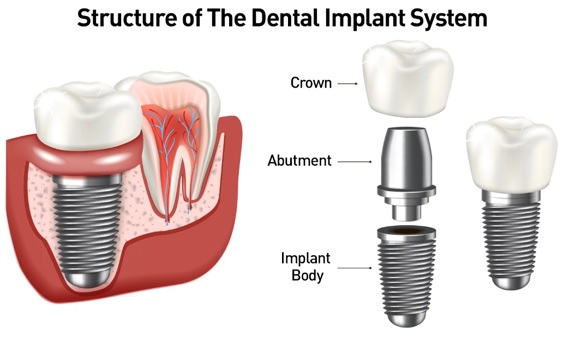 dental implant cost