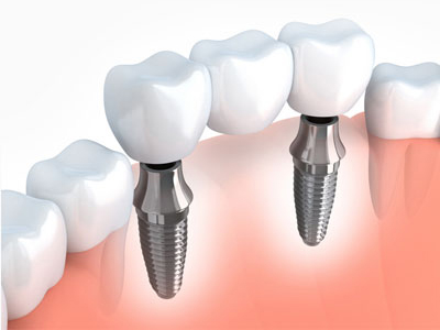 dental implant kochi