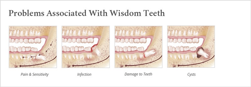 wisdom tooth removal