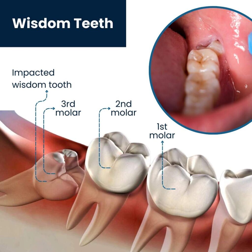 wisdom tooth location