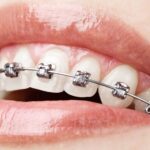 metal braces