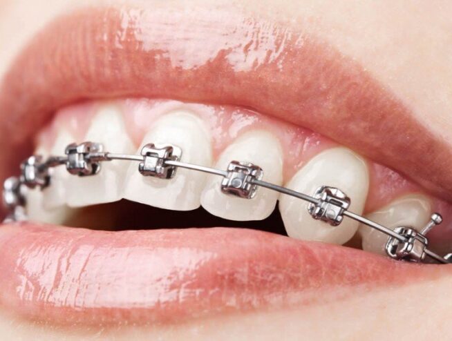 metal braces