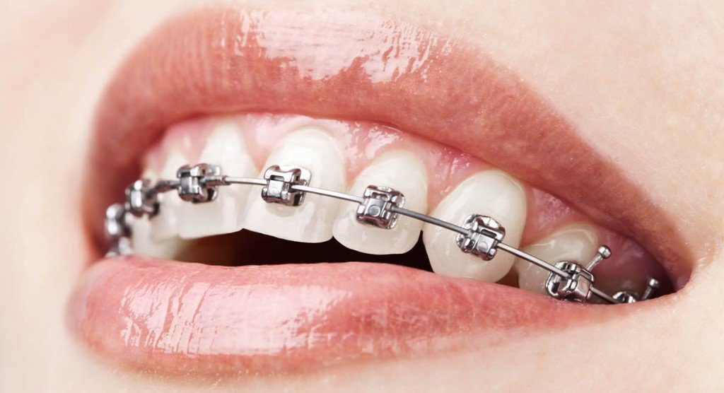 metal braces