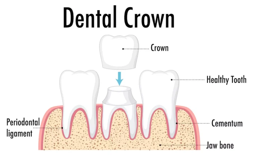 tooth cap