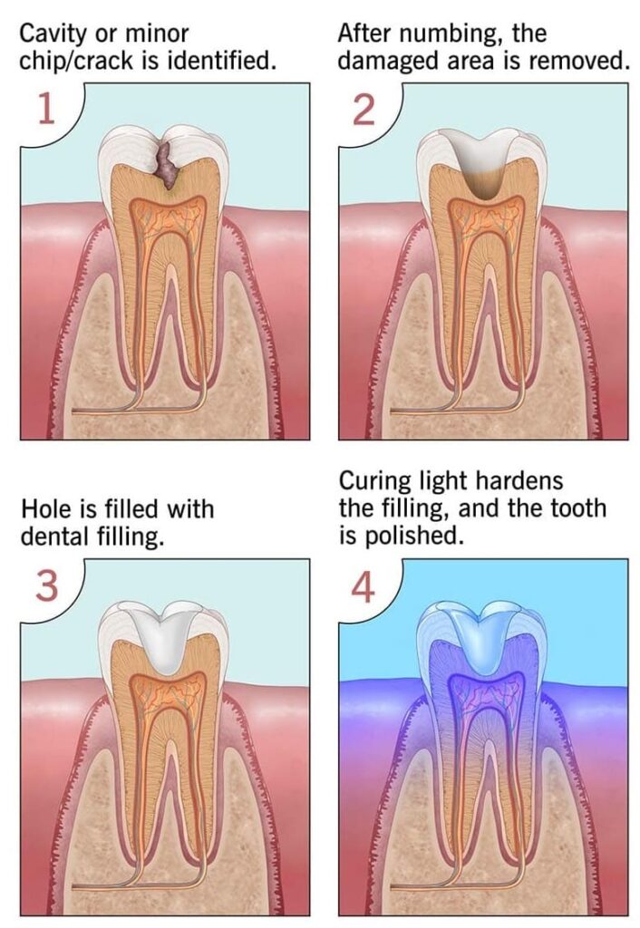 teeth filling