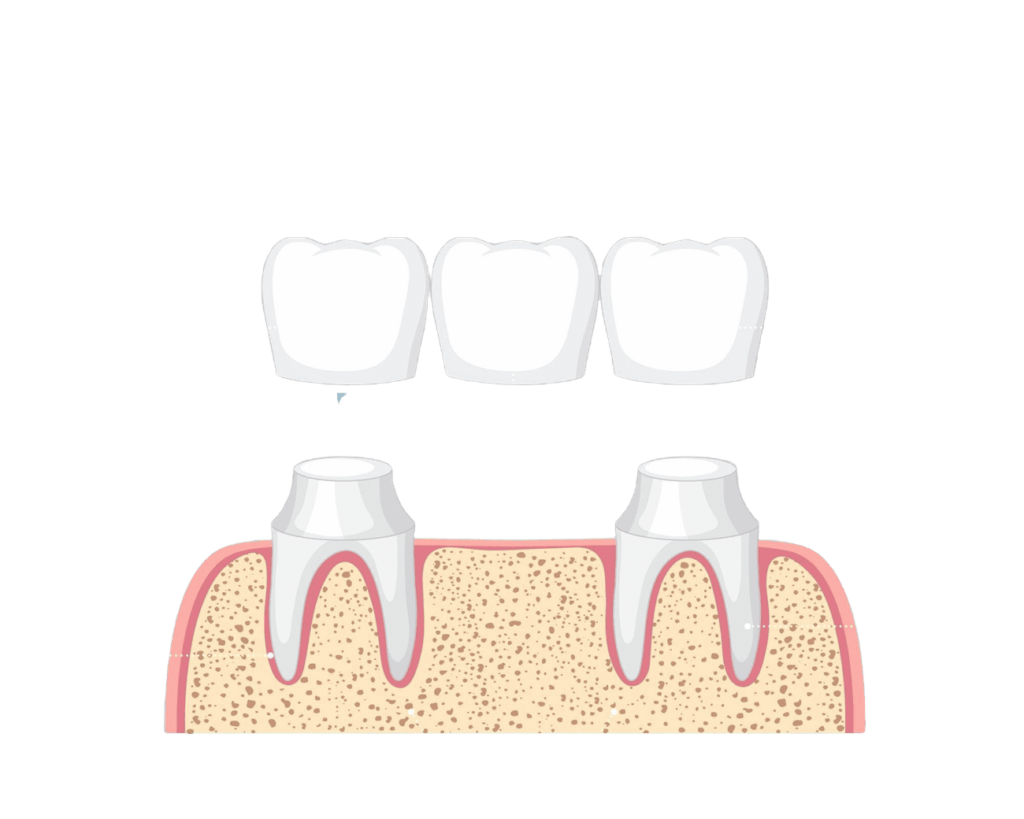 dental implants versus dentures