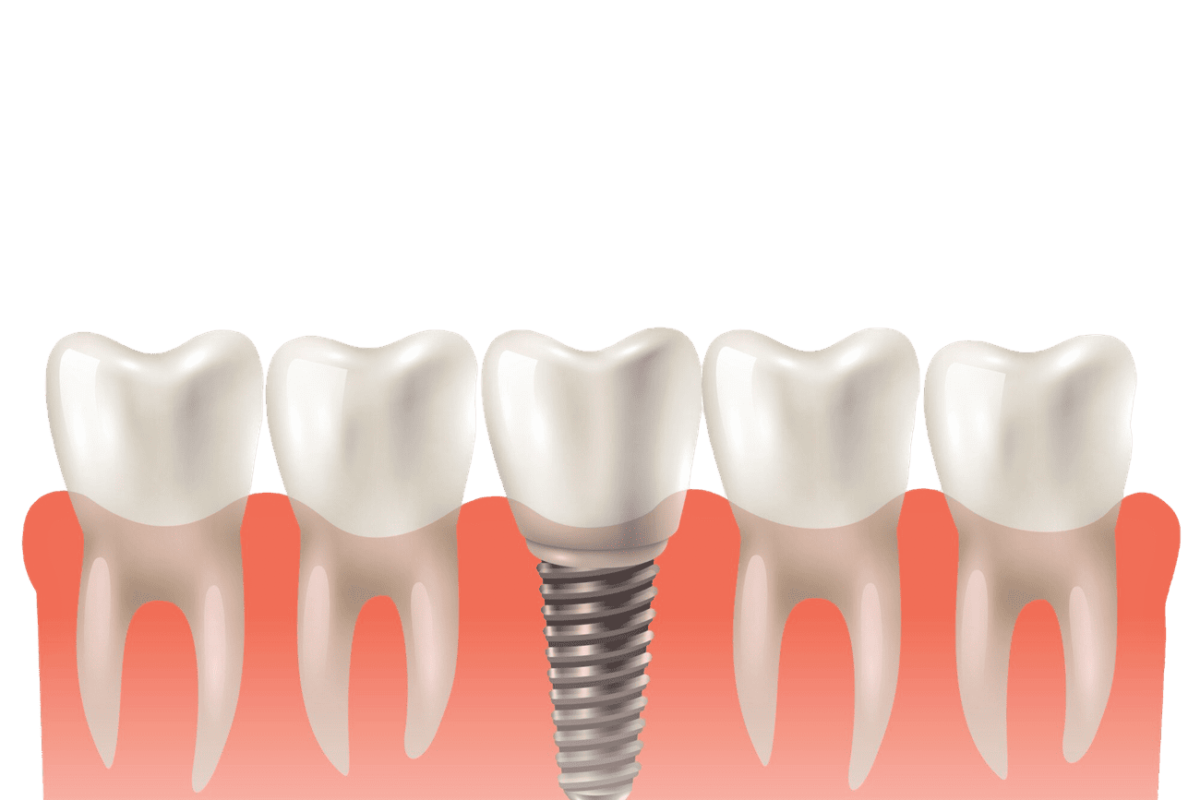 dental implant