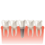 dental implant