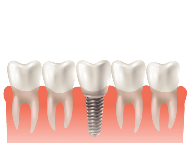 dental implant