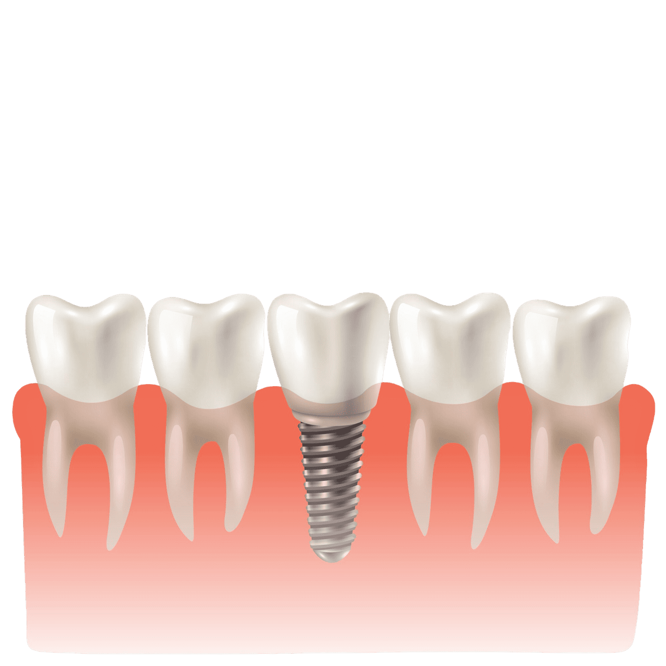 dental implant