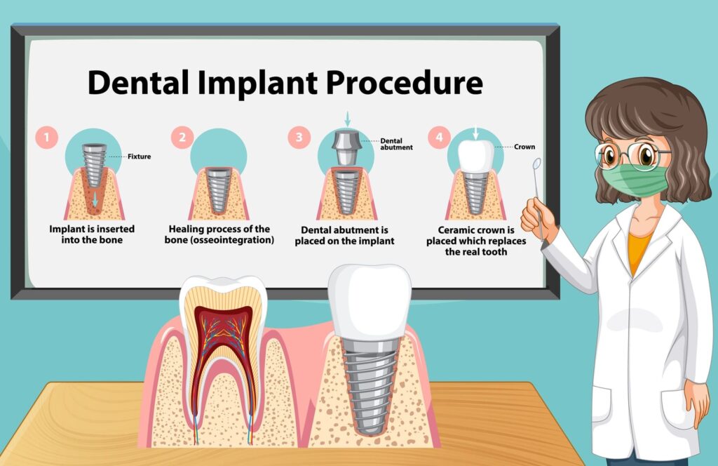 dental implants treatment